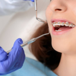 5 Things to Know Before Starting Orthodontic Treatment