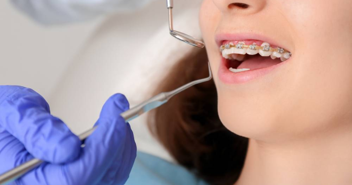 5 Things to Know Before Starting Orthodontic Treatment