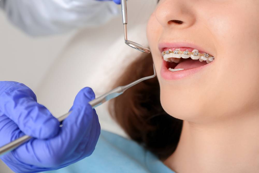 5 Things to Know Before Starting Orthodontic Treatment